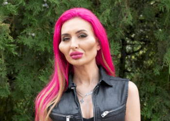 Woman with 'world's biggest cheeks' shares photo taken six years ago to show what she looked like before surgery